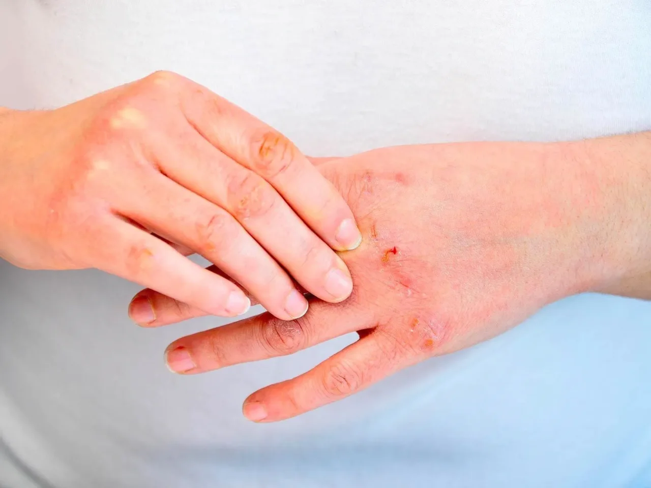 Eczema: il rimedio naturale per farlo sparire